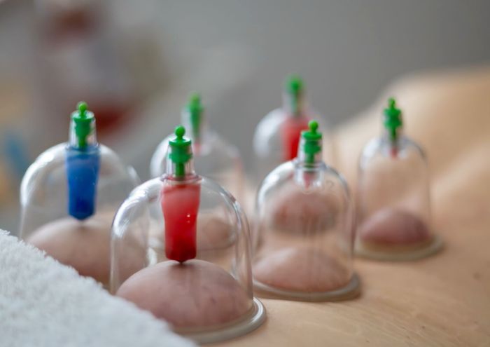 Cupping čašice na leđima